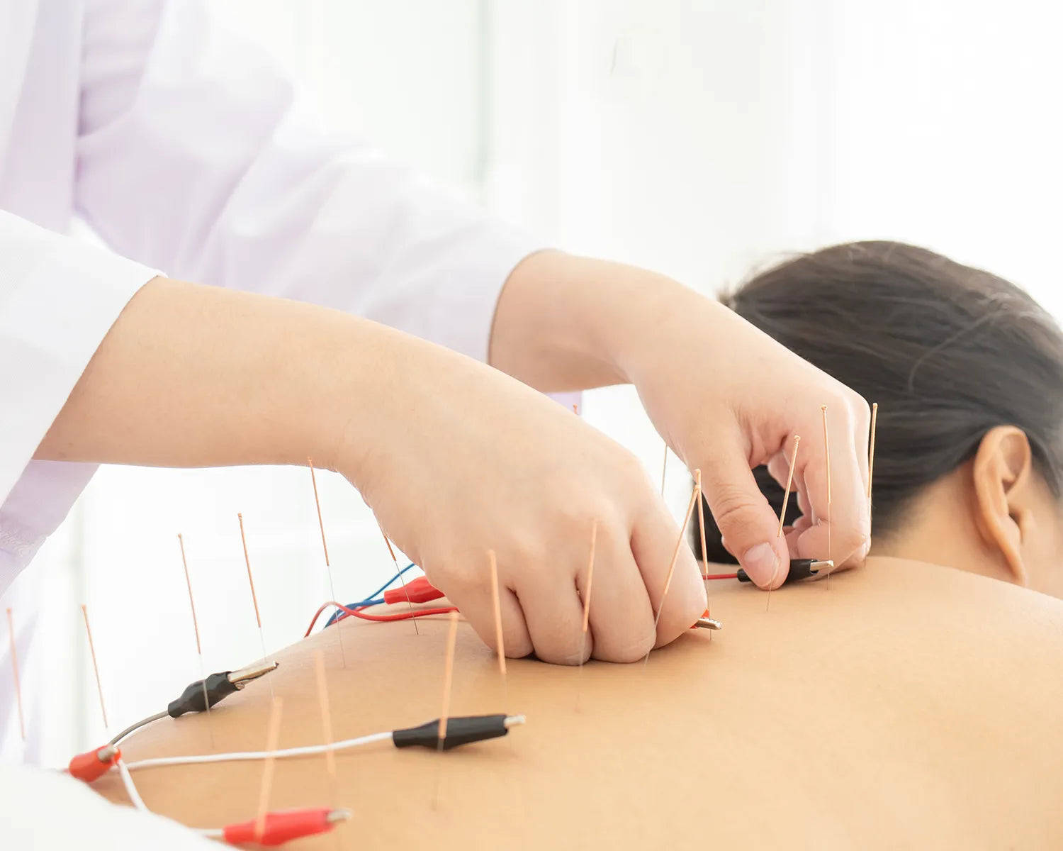 Electric Stimulation Therapy