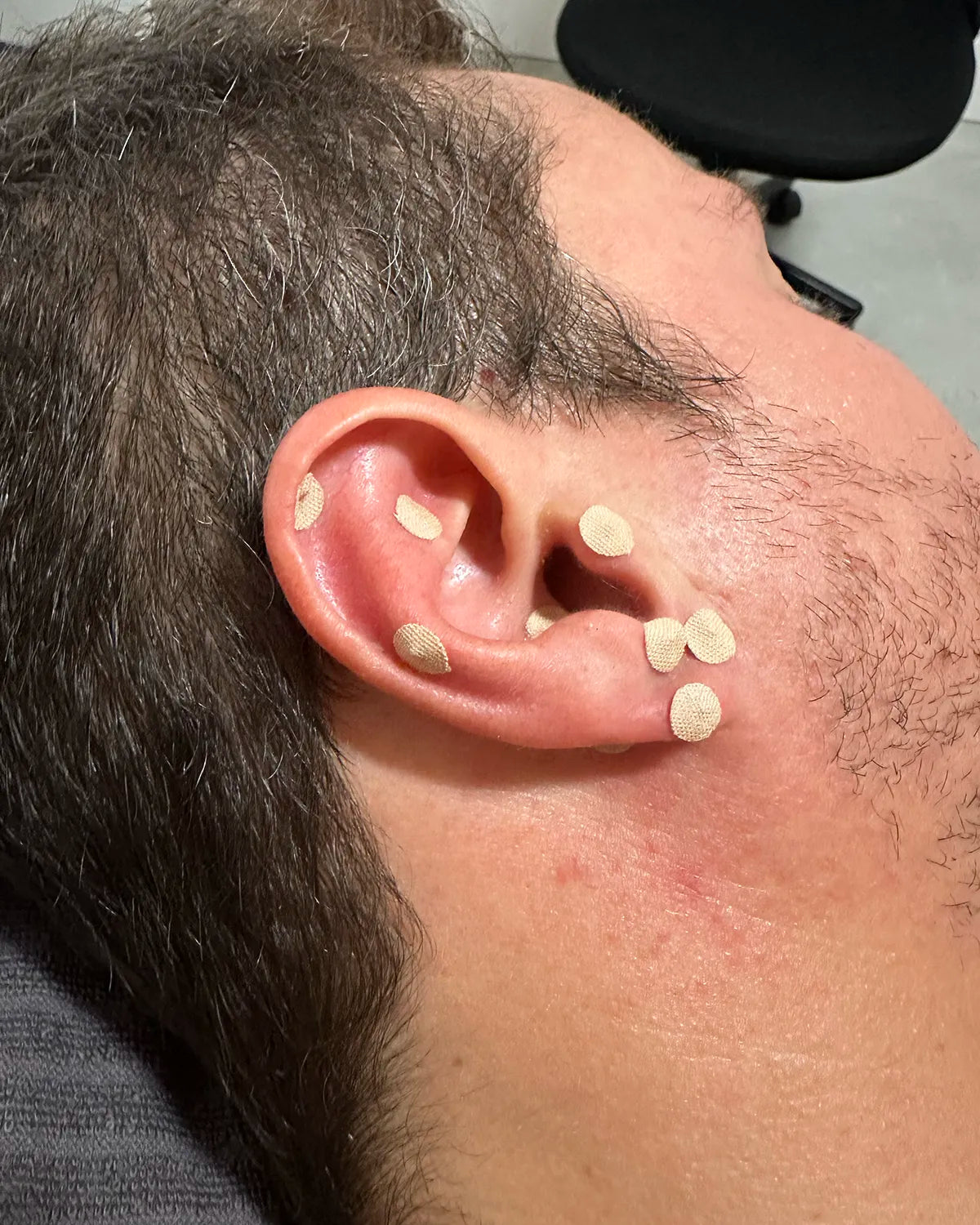 Auriculotherapy